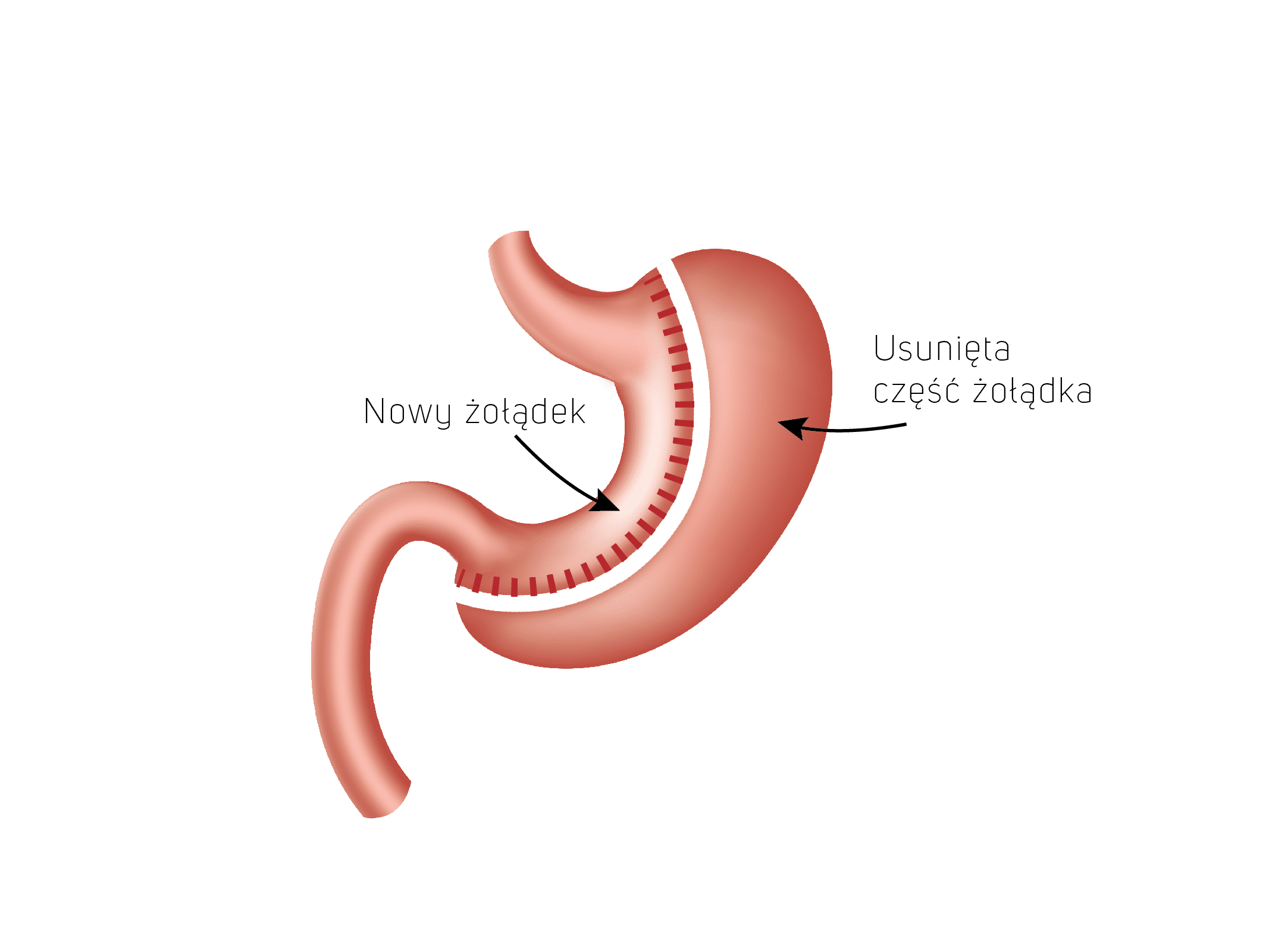 rękawowa resekcja żołądka