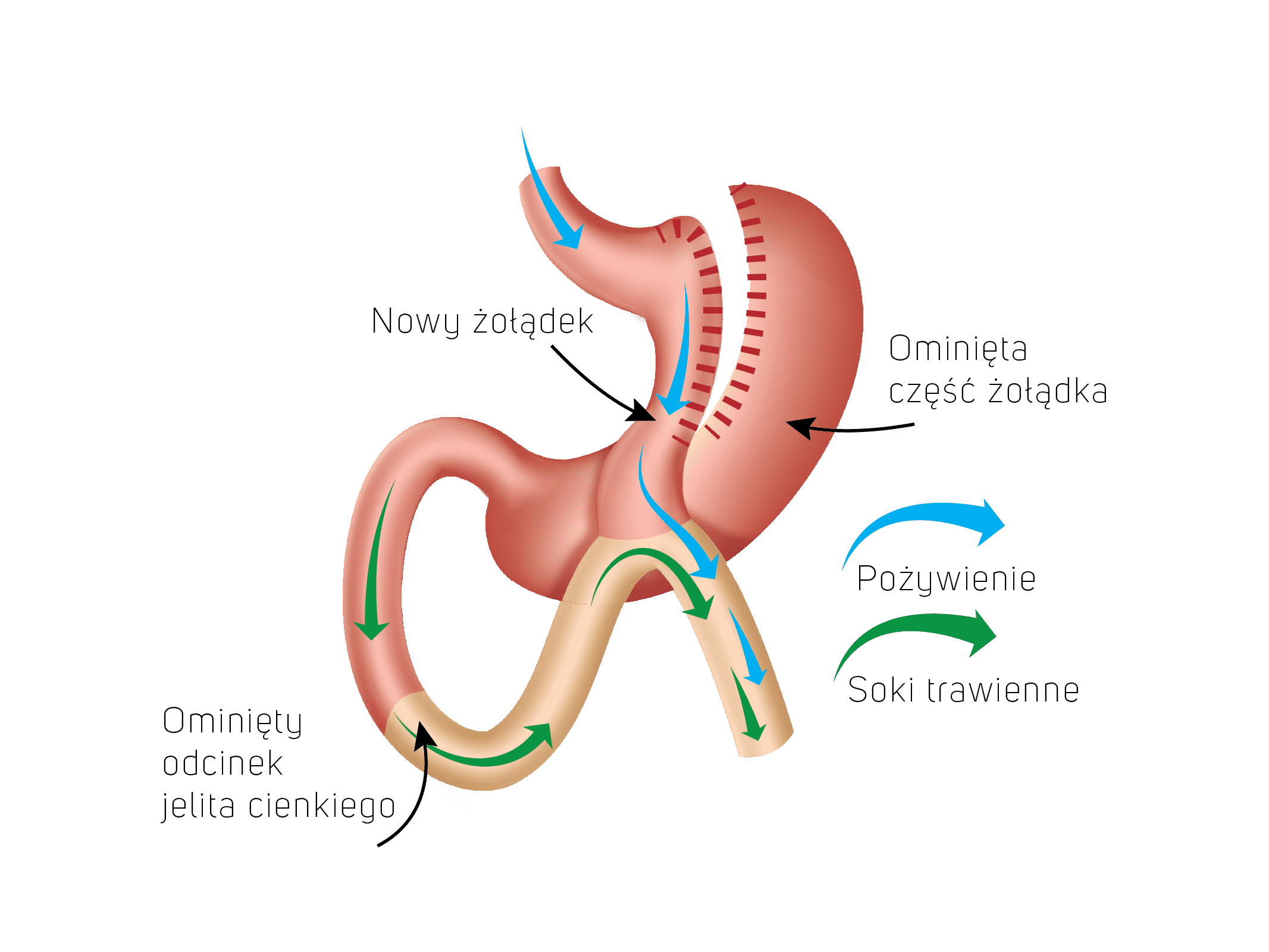 mini-bypass żołądka