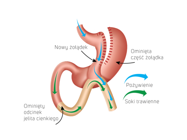 mini bypass żołądka