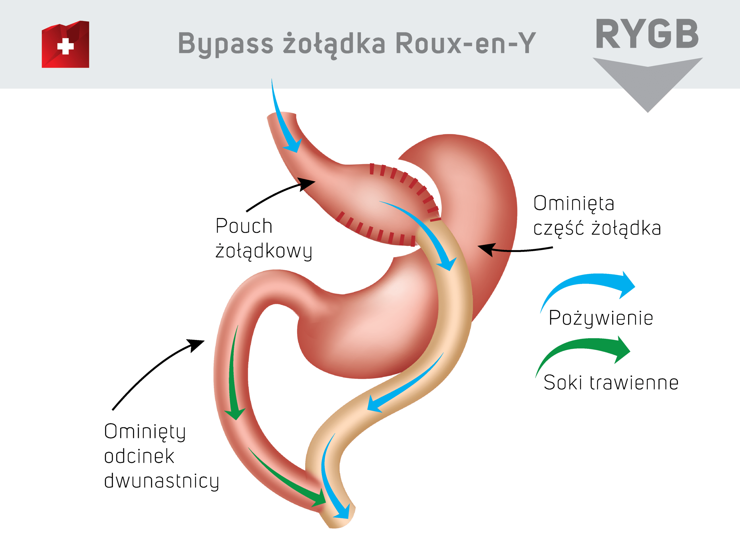 Bypass żołądka Roux-en-Y - pouch żołądkowy / ominięta część żołądka / ominięty odcinek dwunastnicy