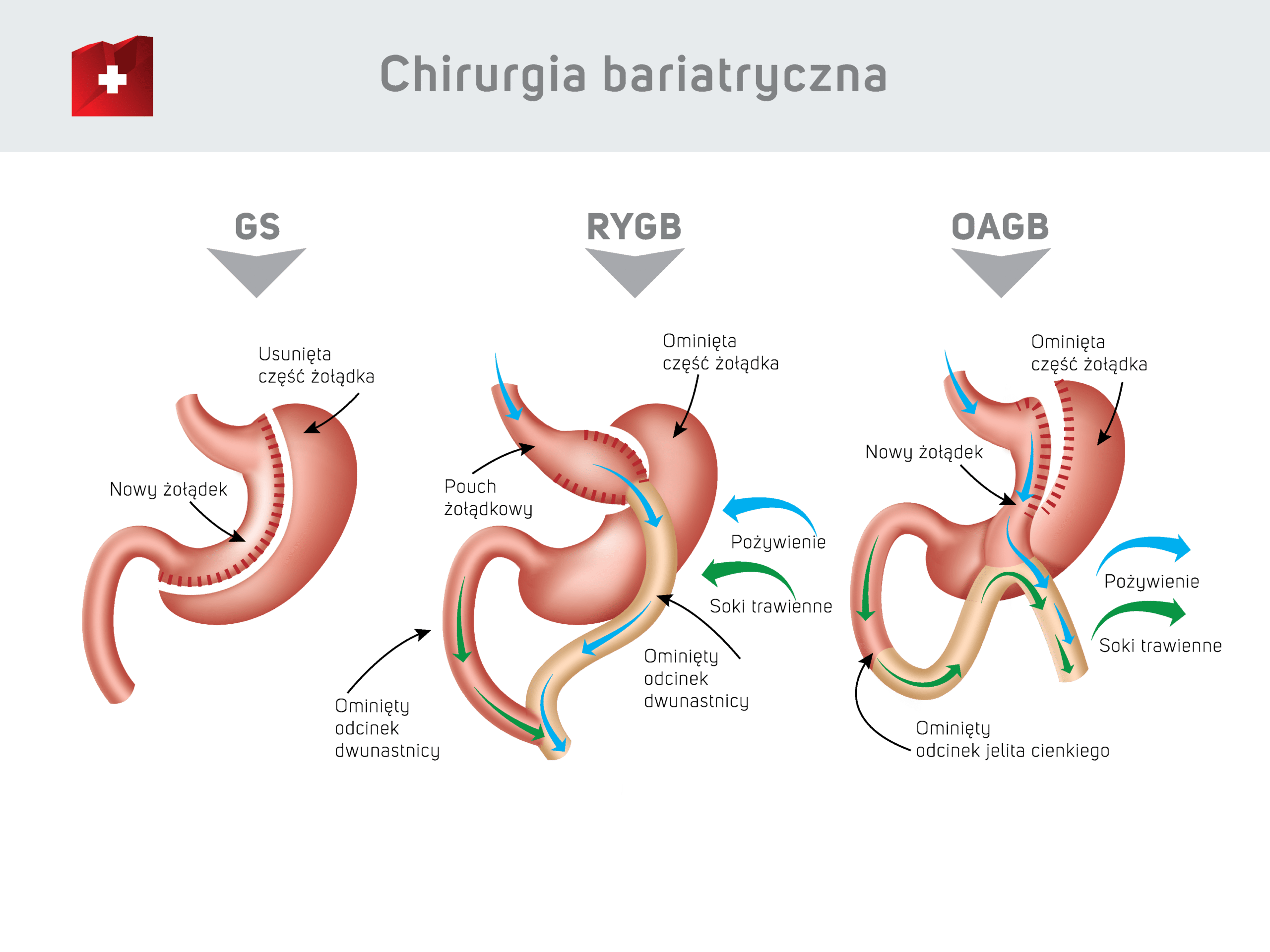 Chrirurgia bariatryczna - zabiegi GS / RYGB / OAGB