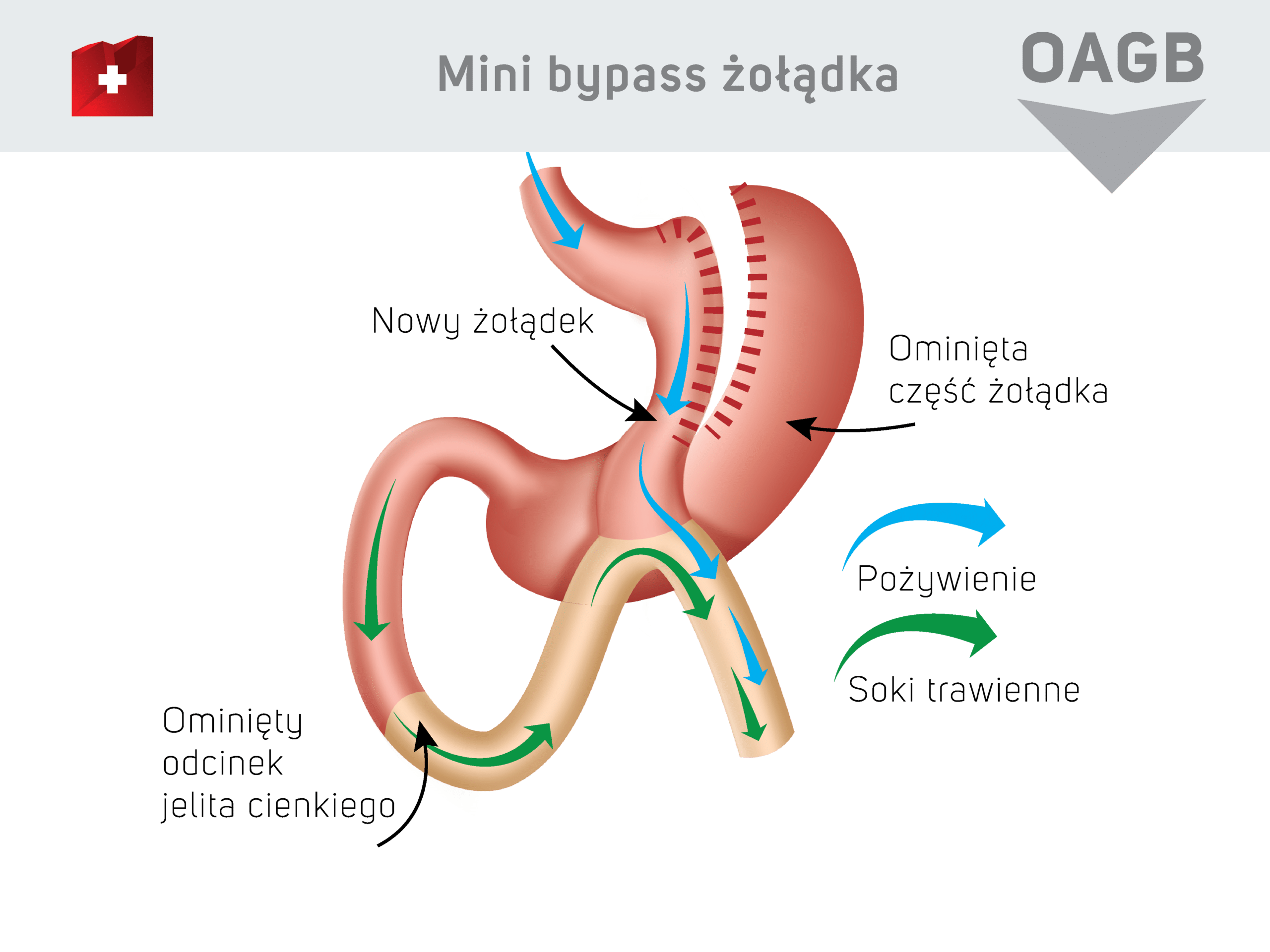 Mini bypass żołądka - nowy żołądek / ominięta część żołądka / ominięty odcinek jelita cienkiego