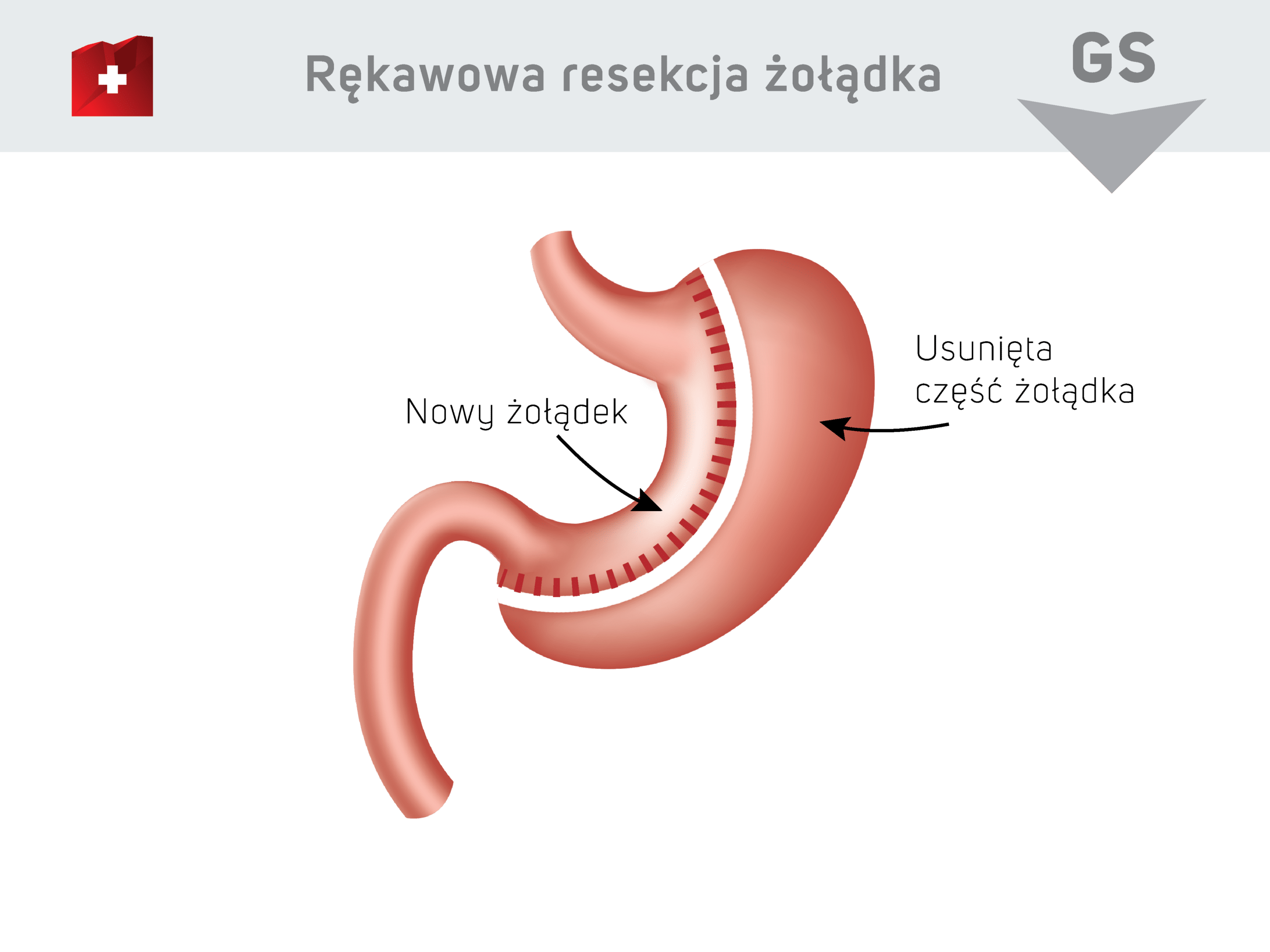 Rękawowa resekcja żołądka - nowy żołądek / usunieta część żołądka