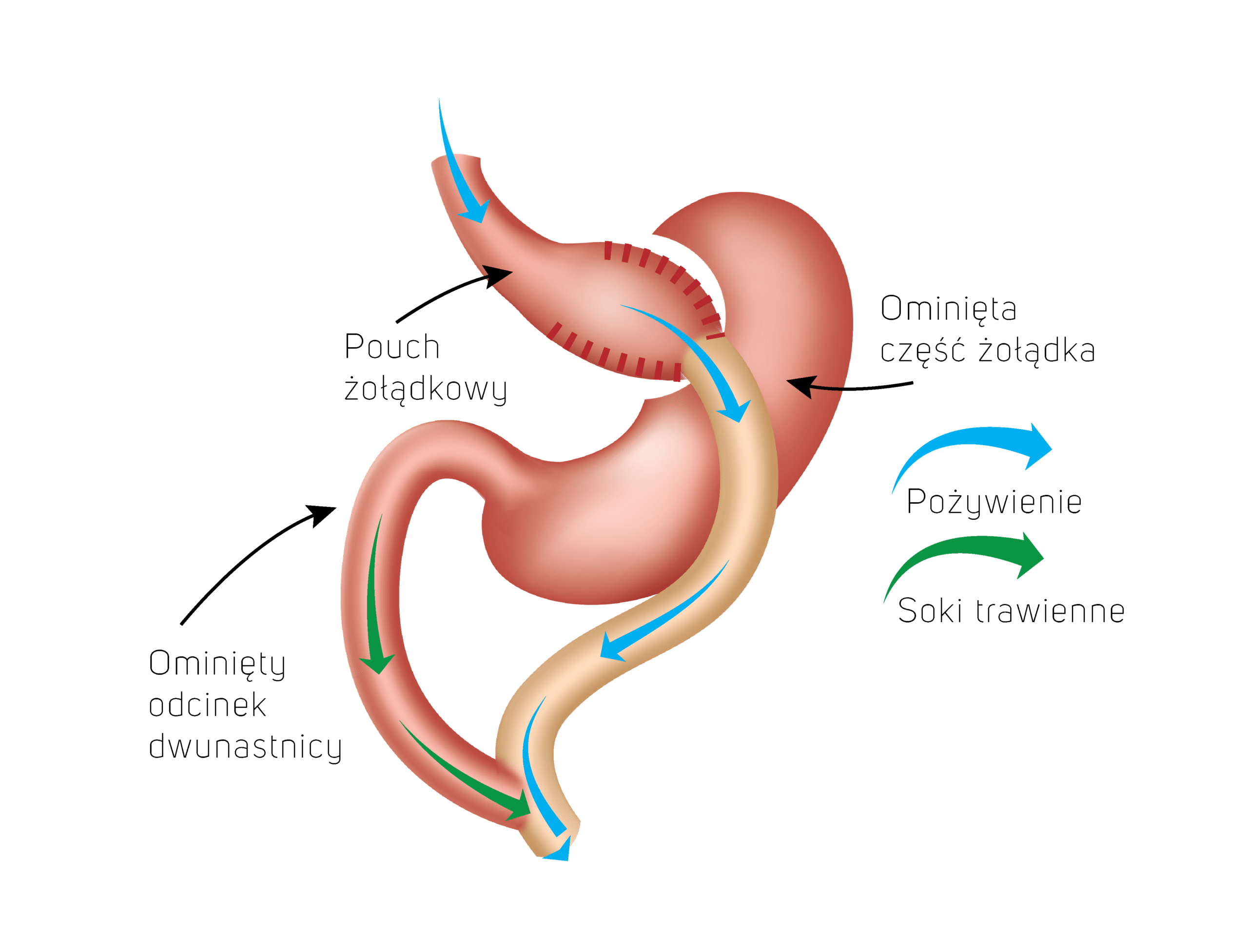 Pouch żołądkowy - ominięta część żołądka - ominięty odcinek dwunastnicy