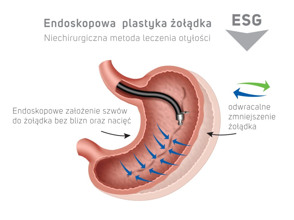 Endoskopowa plastyka żołądka ESG - niechirugiczna metoda leczenia otyłości - odwracalne zmniejszenie żołądka