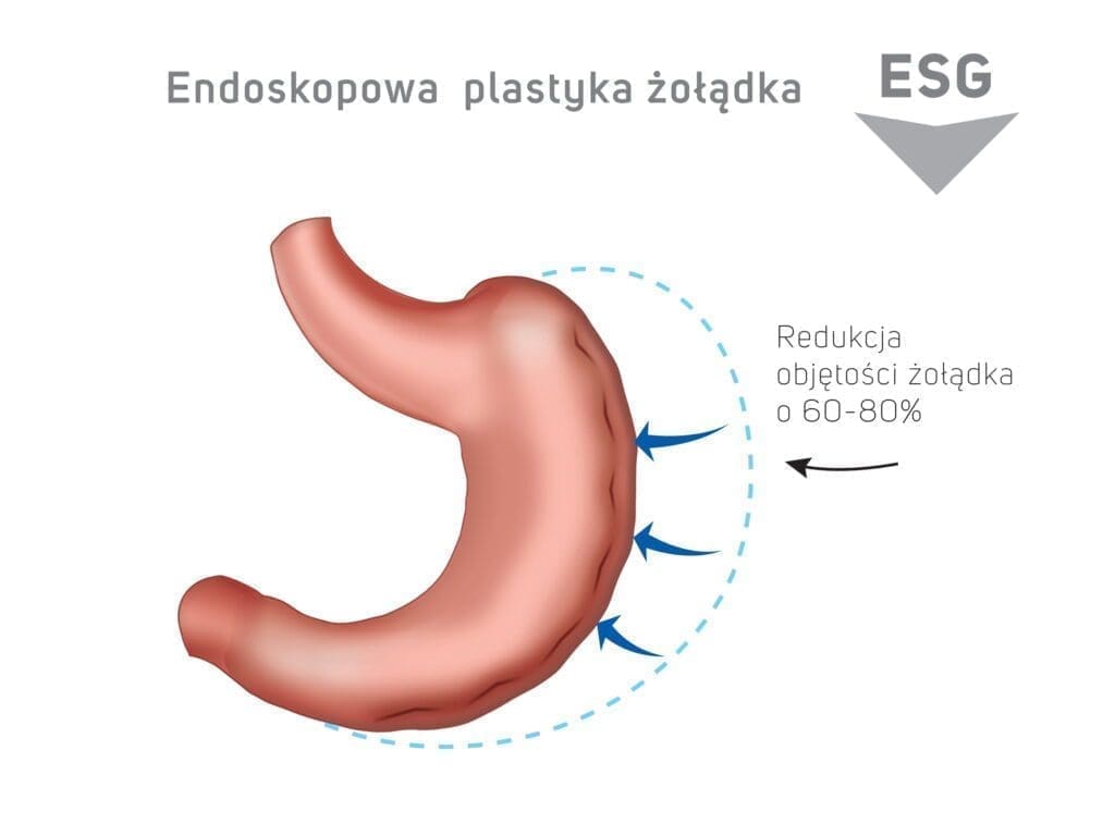 Endoskopowa plastyka żołądka ESG - redukcja objętości żołądka o 60-80%