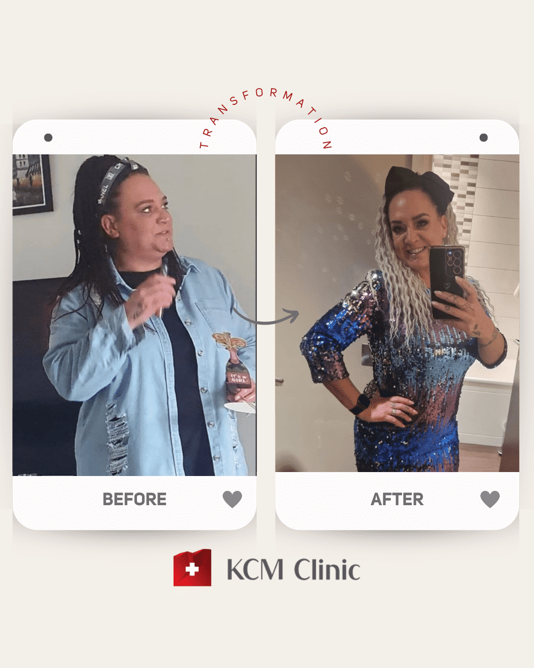 Bariatria otyłość zmniejszenie żołądka weight loss surgery