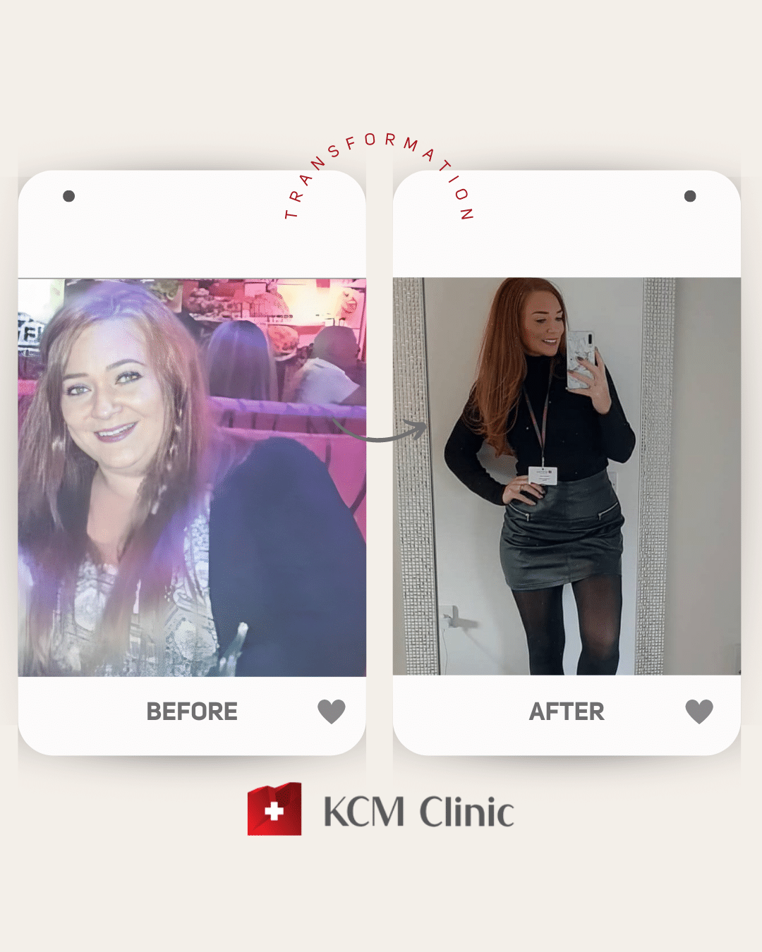 otyłość Bariatria zmniejszenie żołądka weight loss surgery