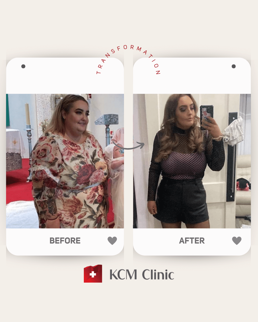 otyłość Bariatria zmniejszenie żołądka weight loss surgery