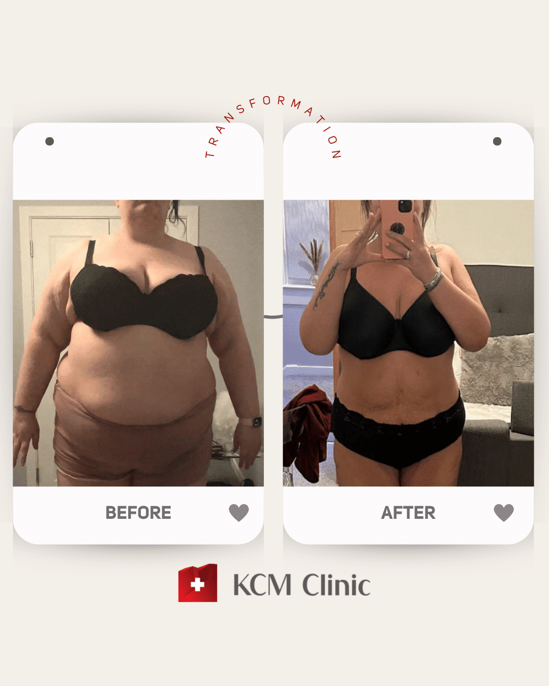 otyłość Bariatria zmniejszenie żołądka weight loss surgery