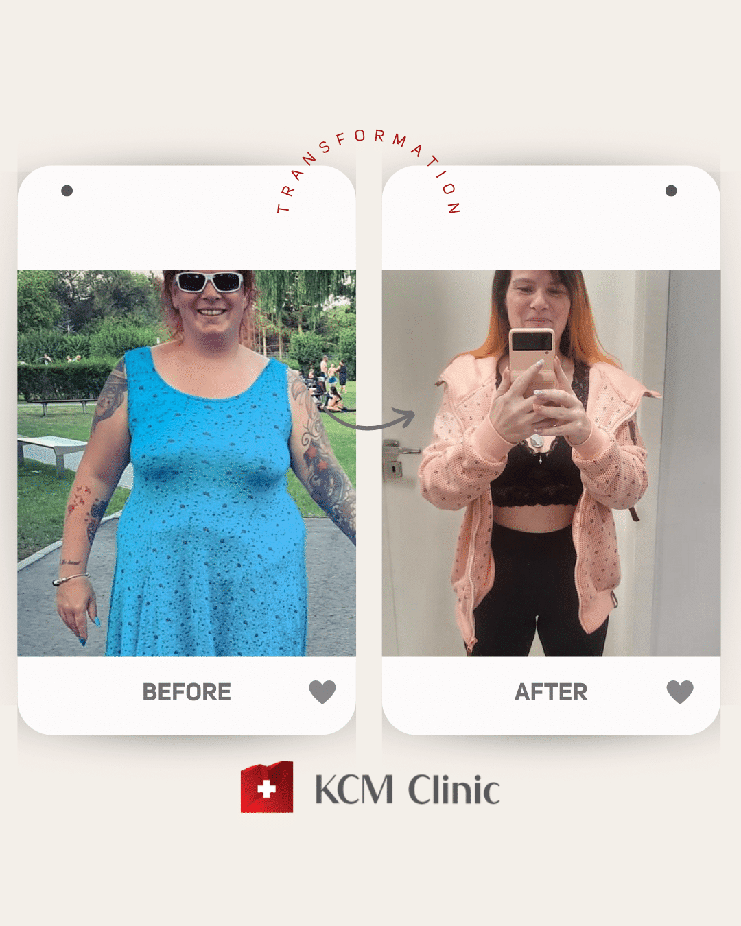 otyłość Bariatria zmniejszenie żołądka weight loss surgery