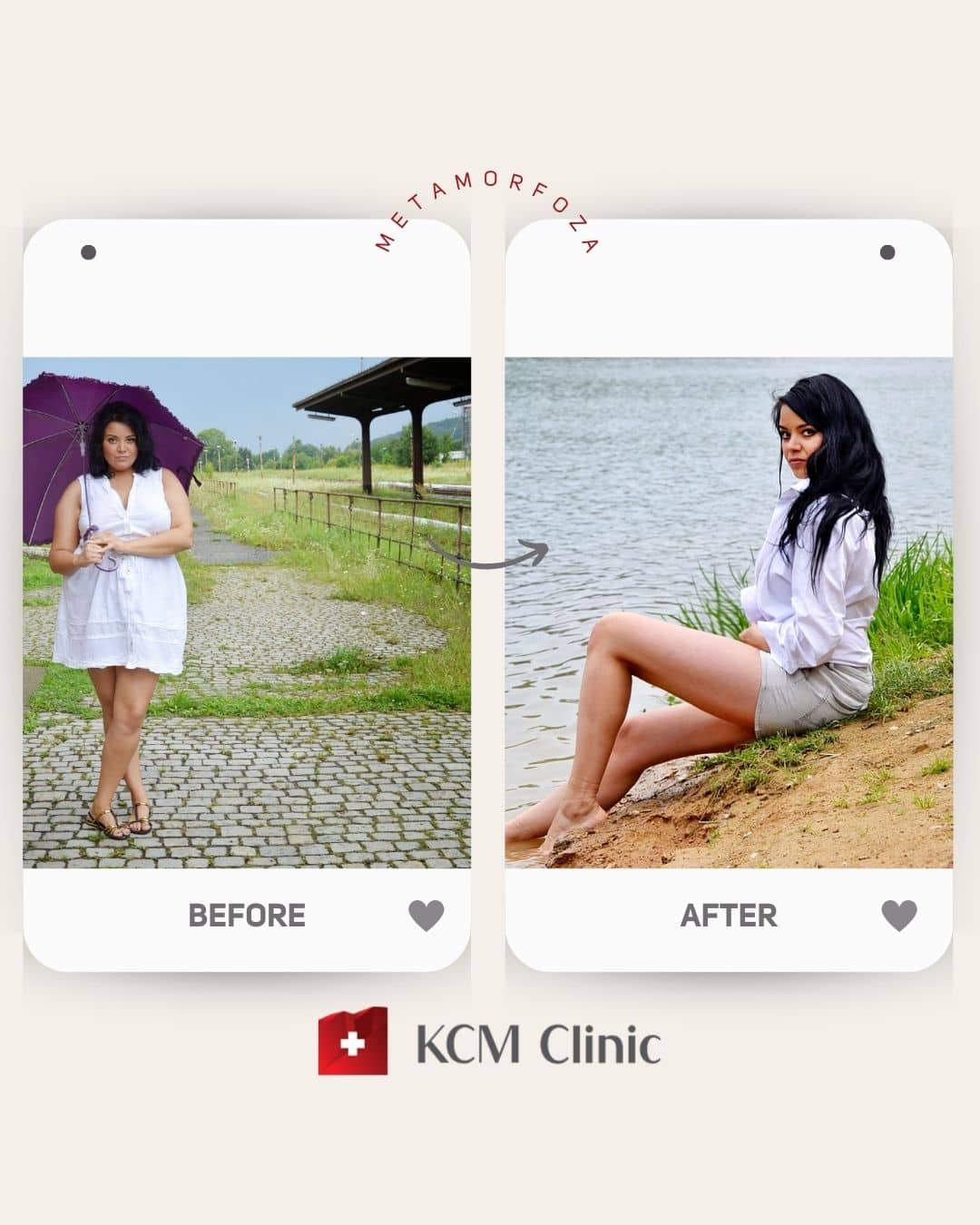 zmniejszenie żołądka weight loss surgery otyłość Bariatria