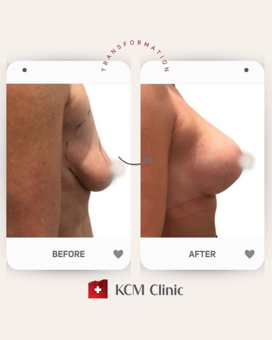 Breast Augmentation with Uplift Plastyczna Operacja Plastic Surgery