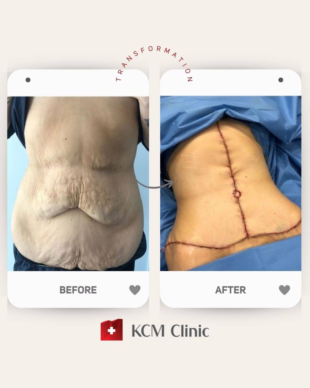 Abdominoplasty with Liposuction Operacja Plastyczna Plastic Surgery