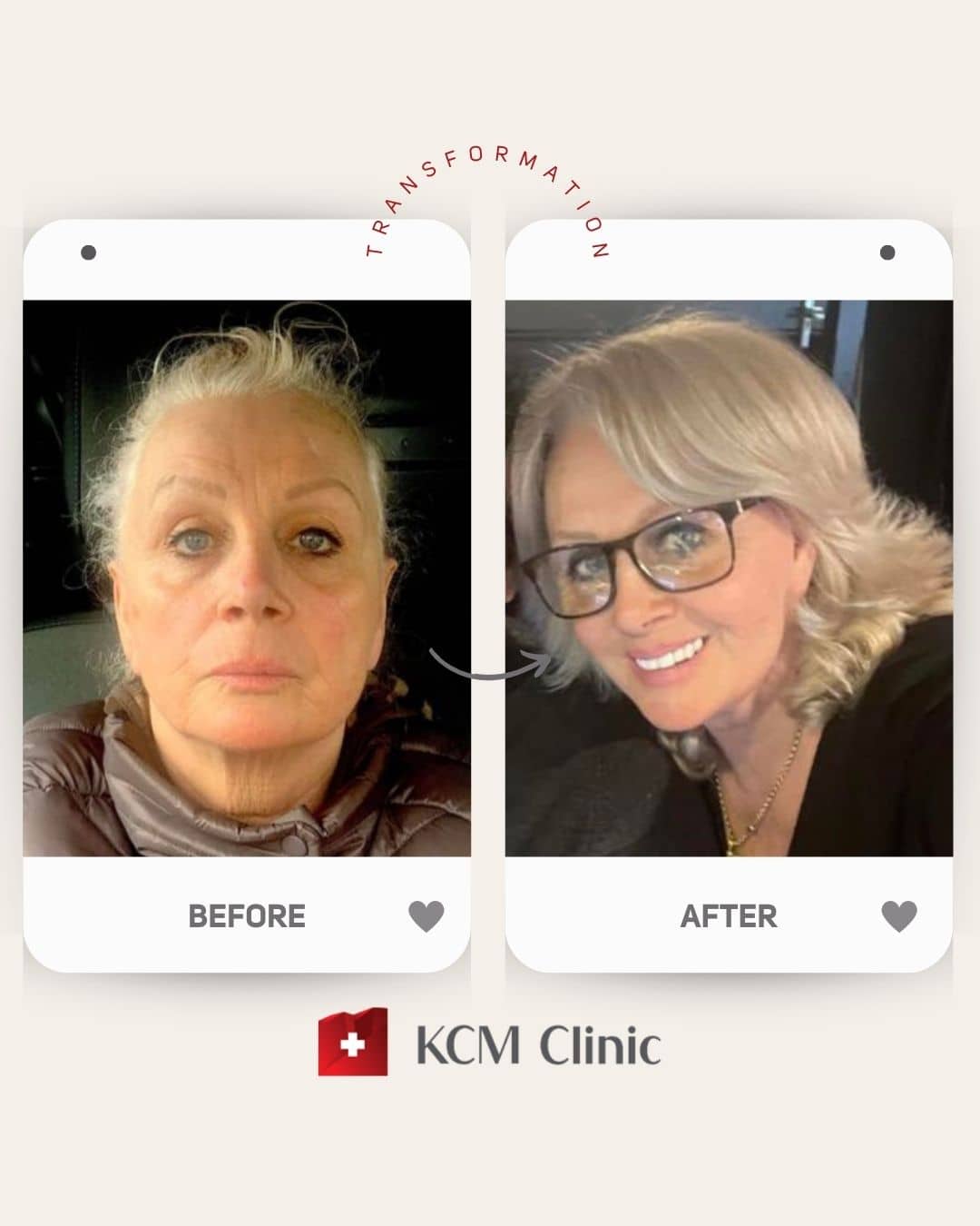 Face and Neck Lifting Operacja Plastyczna Plastic Surgery