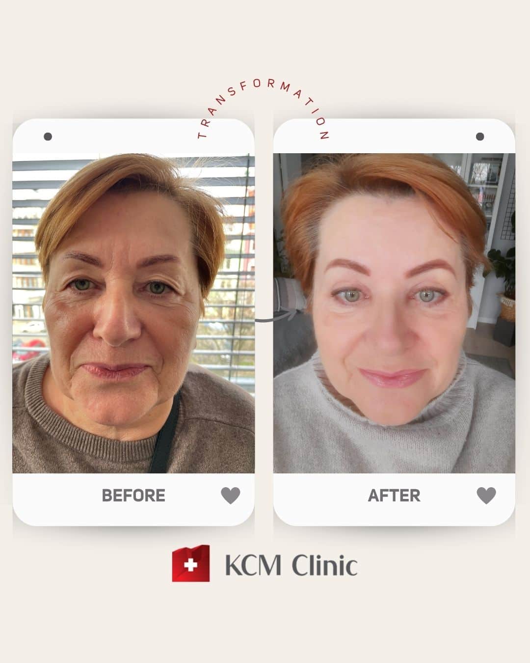 Upper Eyelid Surgery Plastic Surgery Operacja Plastyczna