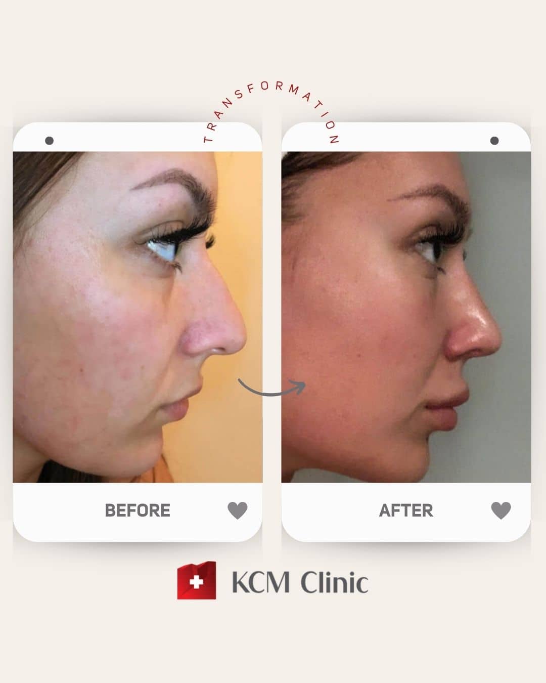 Rhinoplasty Operacja Plastyczna Plastic Surgery