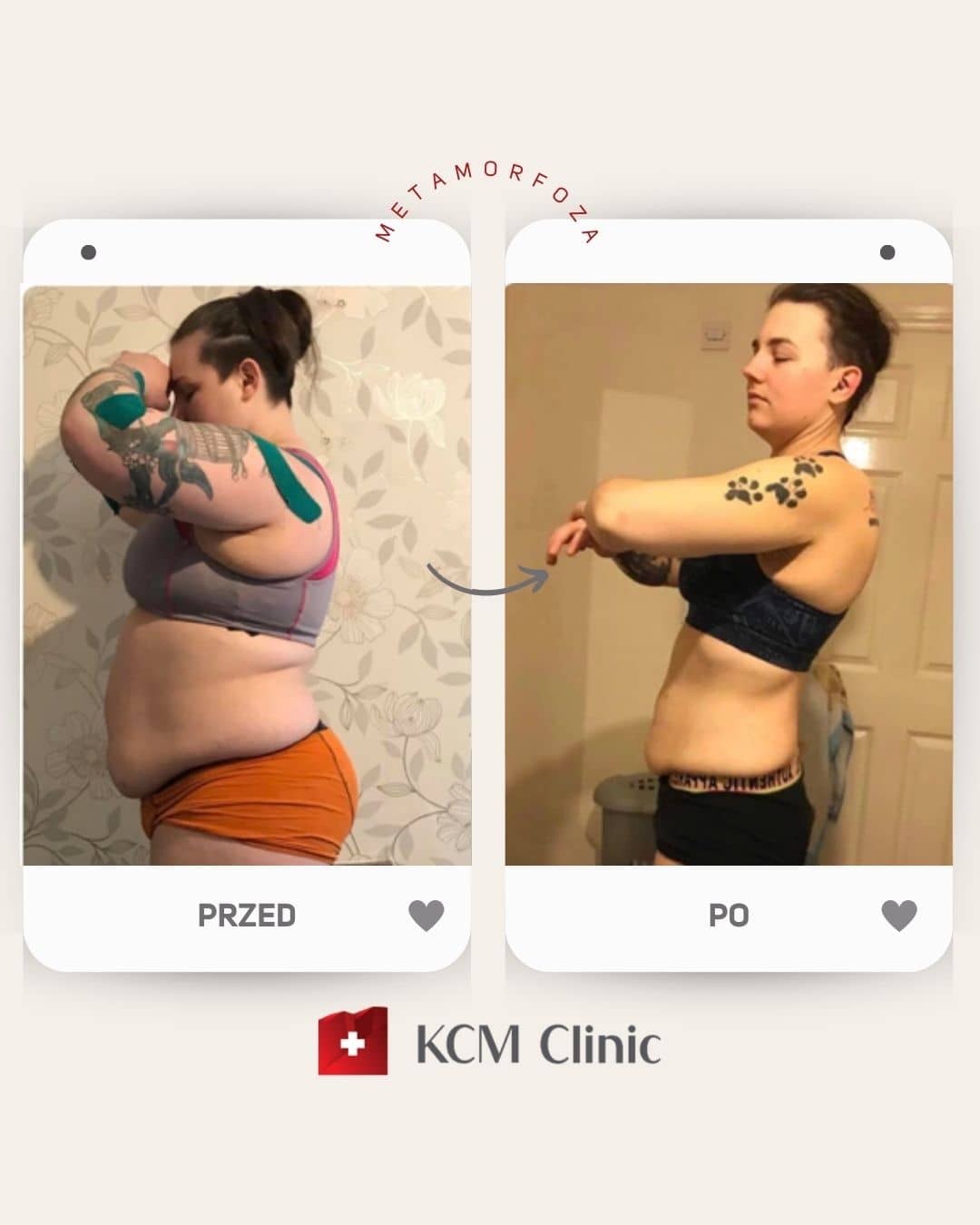 Bariatria otyłość zmniejszenie żołądka