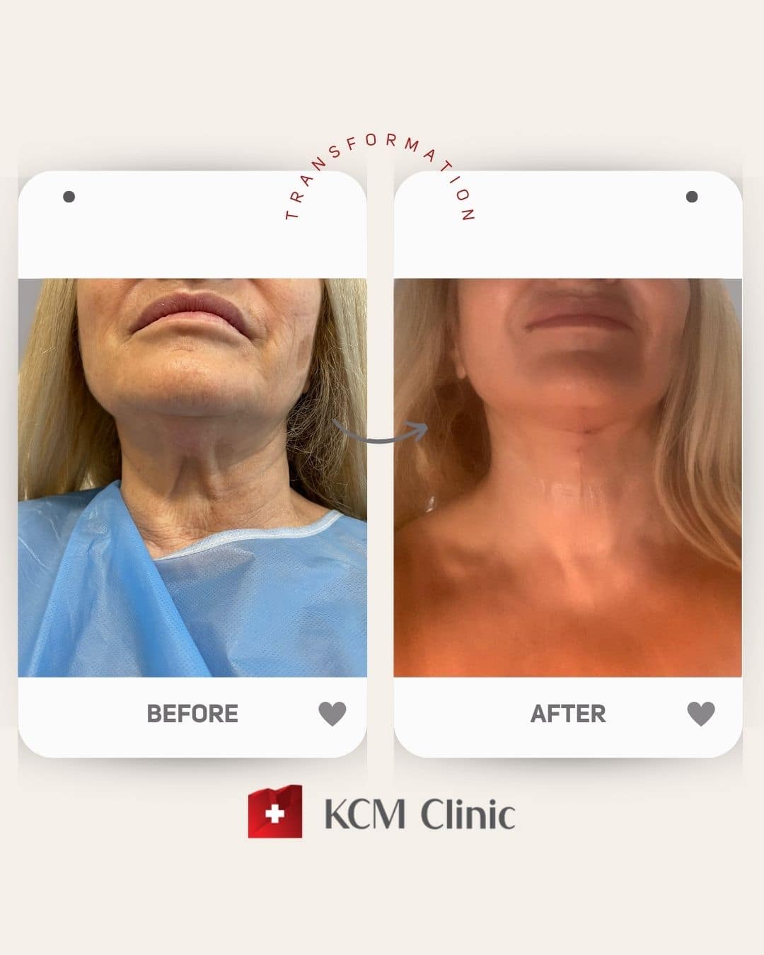 Neck Lift Surgery Plastic Surgery Operacja Plastyczna