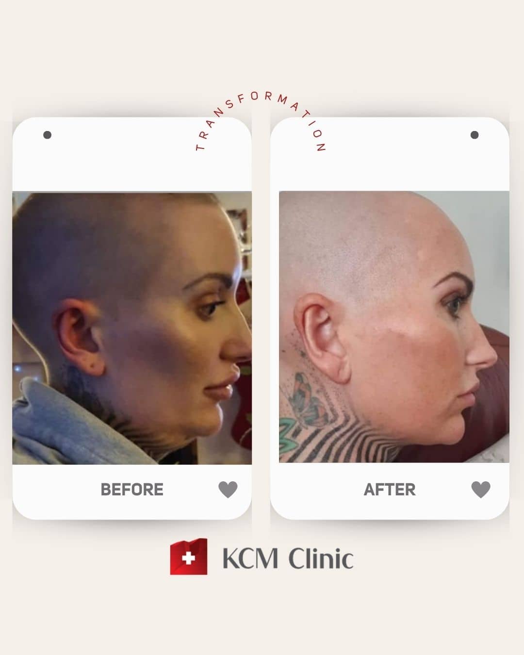 Chin Liposuction Plastic Surgery Operacja Plastyczna