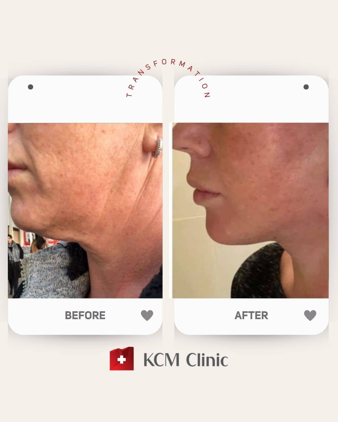 Lower Facelift Plastic Surgery operacja Plastyczna