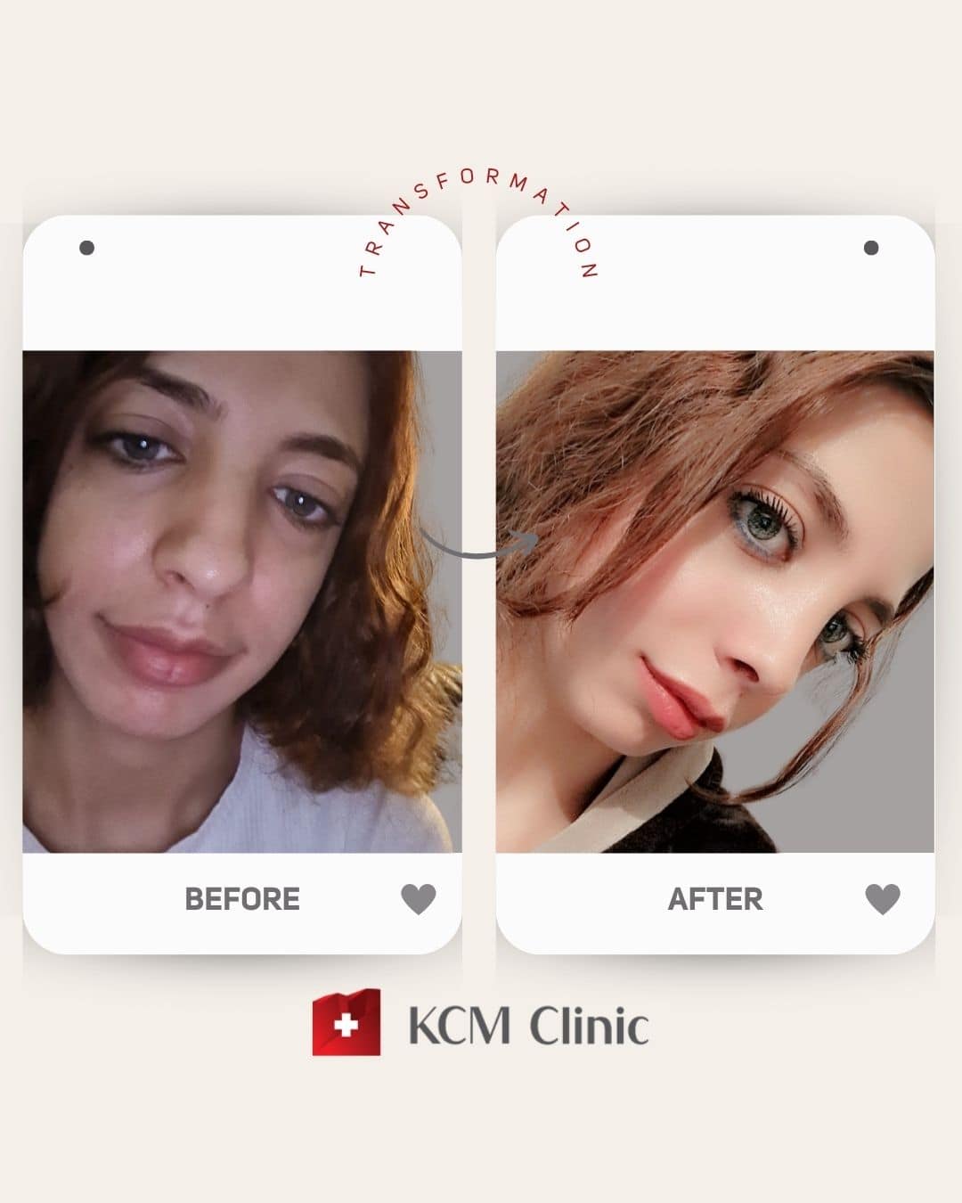 Rhinoplasty Operacja Plastyczna Plastic Surgery