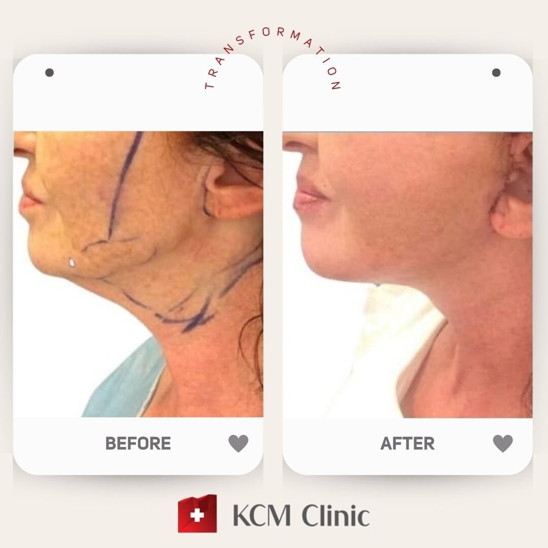 Face and Neck Lifting Plastic Surgery Operacja Plastyczna