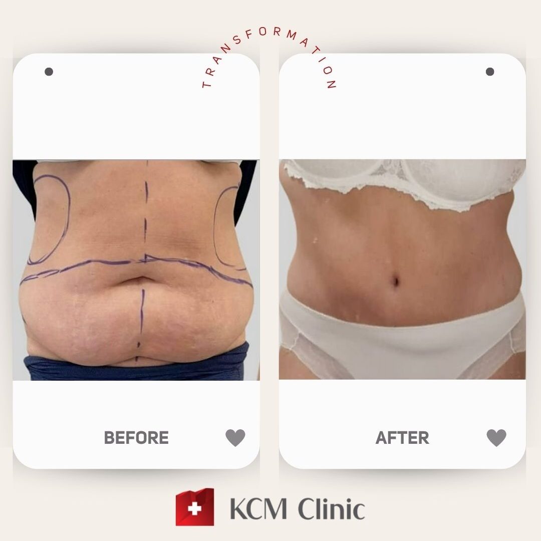 Abdominoplasty with Liposuction Plastic Surgery Operacja Plastyczna