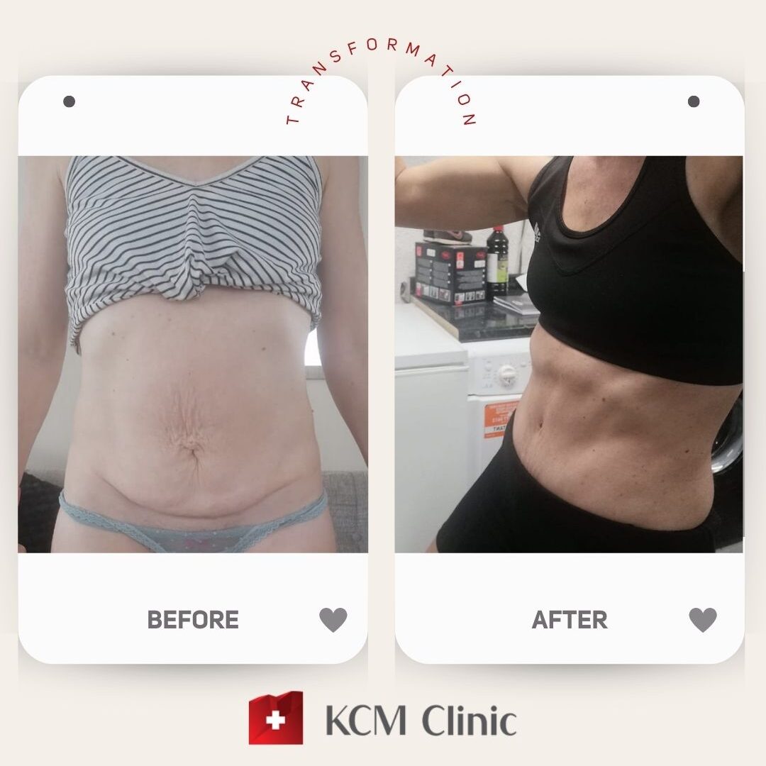 Abdominoplasty with Liposuction Plastic Surgery Operacja Plastyczna