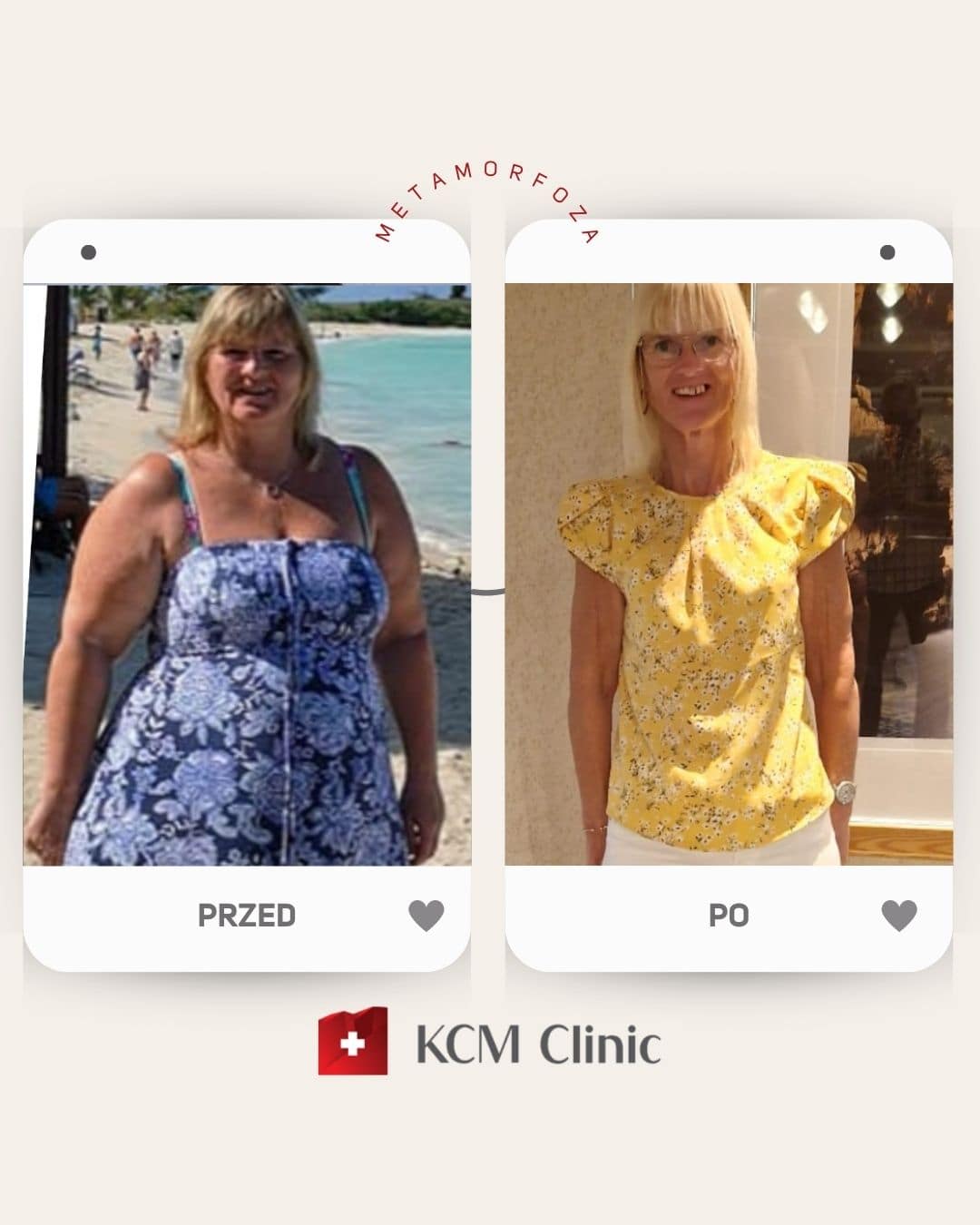 otyłość zmniejszenie żołądka Bariatria weight loss surgery