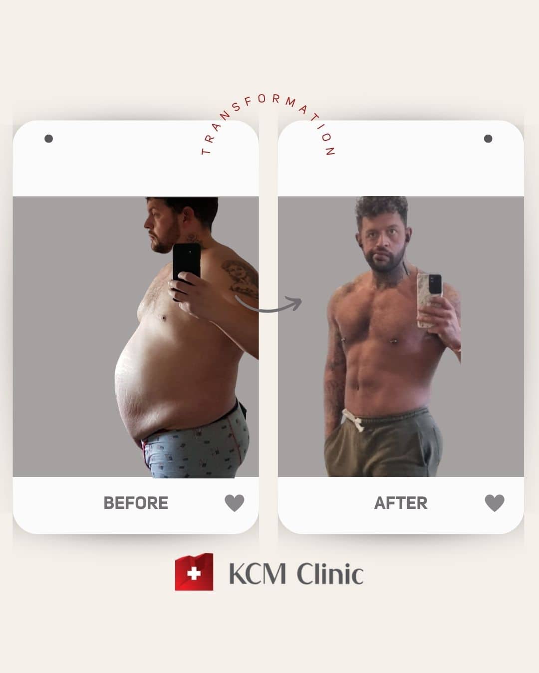 zmniejszenie żołądka weight loss surgery Bariatria otyłość