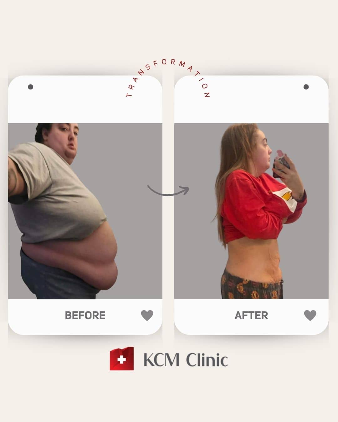 weight loss surgery zmniejszenie żołądka otyłość Bariatria