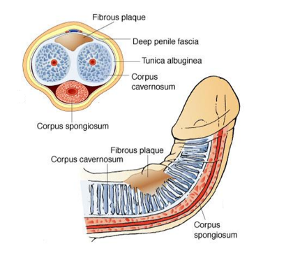 Choroba Peyroniego