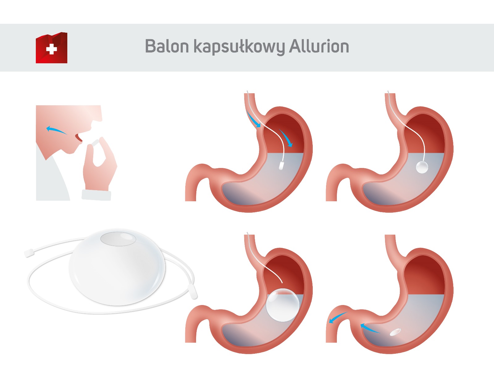 Balon kapsułkowy Allurion KCM Jelenia Góra
