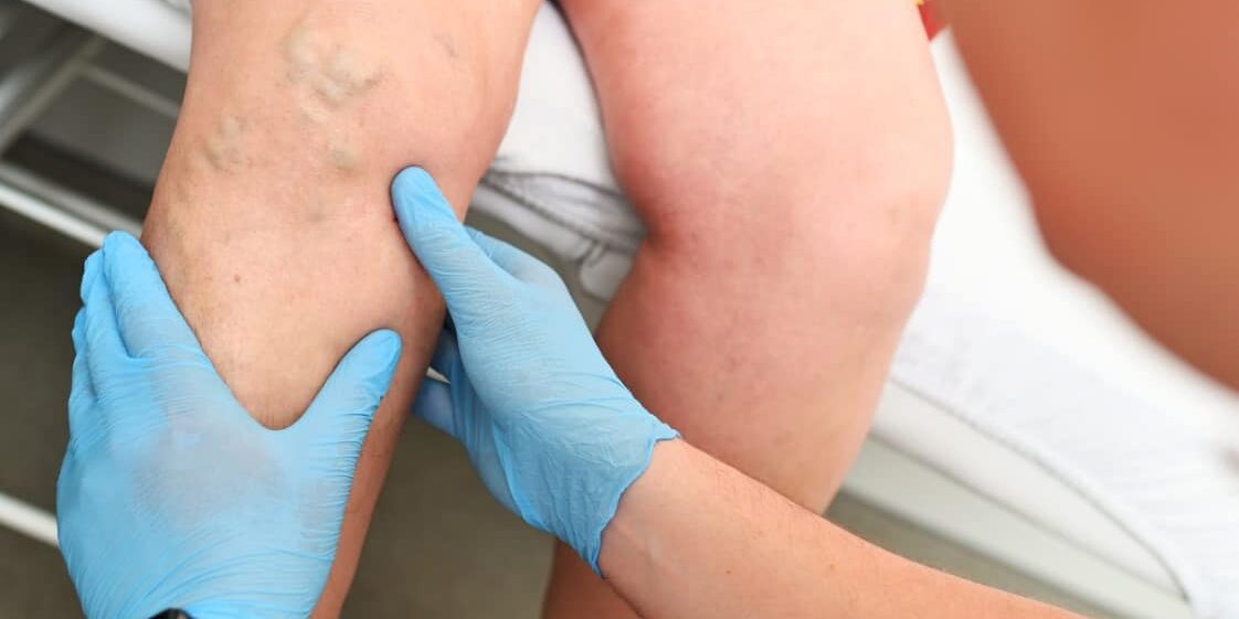 hlebologist examines a patient with varicose veins on his leg. Laserowe usuwanie żylaków